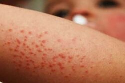 Confirman dos nuevos casos de sarampión en Hidalgo